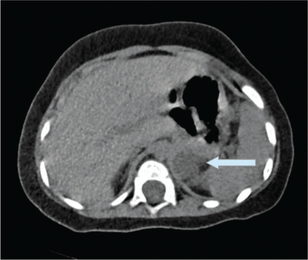 Prenatal diagnosis of an adrenal mature teratoma mimicking a neuroblastoma.