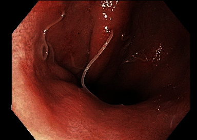 Gastric Anisakiasis Masquerading as Gastroesophageal Reflux Disease.