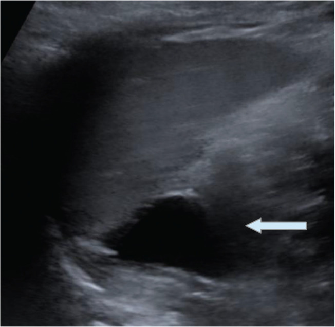 Prenatal diagnosis of an adrenal mature teratoma mimicking a neuroblastoma.