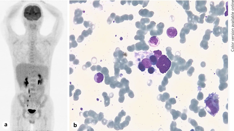 A Case of Hemophagocytic Lymphohistiocytosis following Second Dose of COVID-19 Vaccination.