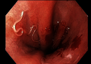 Gastric Anisakiasis Masquerading as Gastroesophageal Reflux Disease.