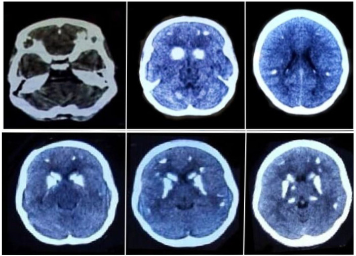 Fahr's Syndrome Secondary to Primary Hypoparathyroidism Presenting With Seizures and the Role of Steroid Therapy.