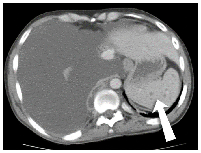 Disseminated MAI in an HIV Patient-An Unusual Presentation.