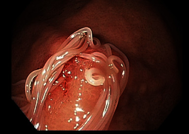 Gastric Anisakiasis Masquerading as Gastroesophageal Reflux Disease.