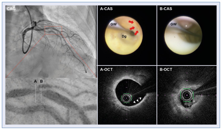 Type II Kounis syndrome diagnosed by optical coherence tomography and coronary angioscopy.