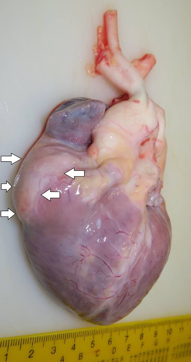 Ventricular fibrillation and arrhythmia associated with cardiac fibromas involving both ventricles in a 1.5-year-old girl.