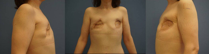 Using an anterolateral thigh flap in autologous breast reconstruction as a salvage procedure in a patient with adult-onset Still's disease: A case report.