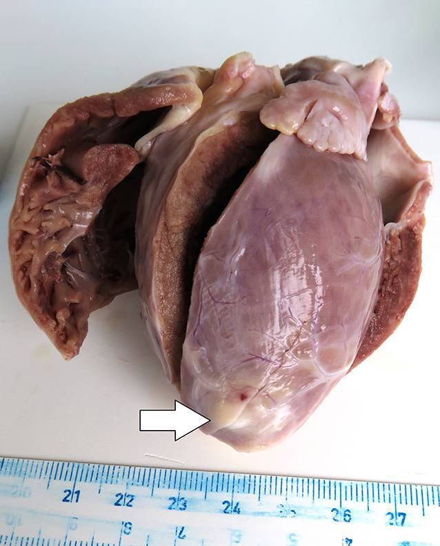 Ventricular fibrillation and arrhythmia associated with cardiac fibromas involving both ventricles in a 1.5-year-old girl.