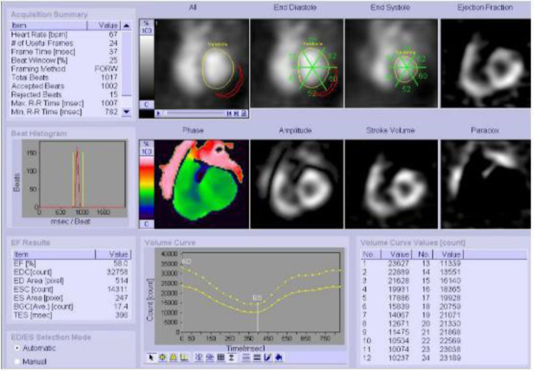 Left ventricular ejection fraction by multigated acquisition scan using planar sodium iodide and cadmium-zinc-telluride cameras: a comparison with two-dimensional echocardiography.