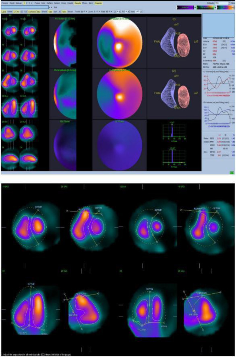 Left ventricular ejection fraction by multigated acquisition scan using planar sodium iodide and cadmium-zinc-telluride cameras: a comparison with two-dimensional echocardiography.