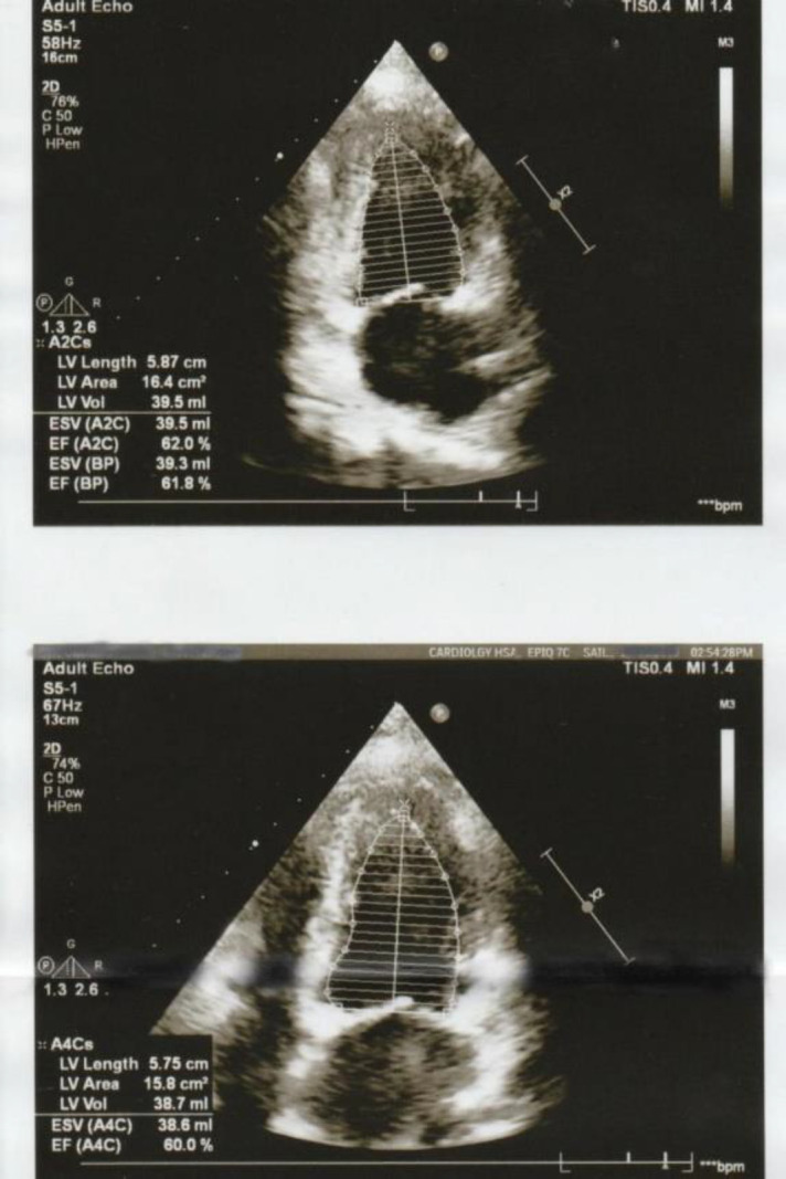 Left ventricular ejection fraction by multigated acquisition scan using planar sodium iodide and cadmium-zinc-telluride cameras: a comparison with two-dimensional echocardiography.