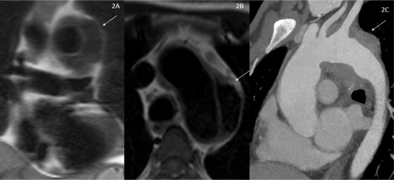 Pictorial review of computed tomography and magnetic resonance imaging findings of cardiovascular manifestations of IgG4-related disease.