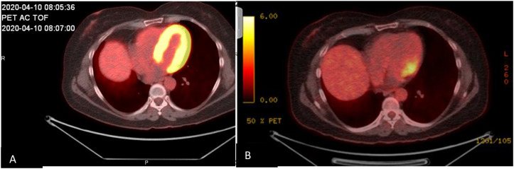 Case Report: Immune checkpoint inhibitor-induced multiorgan vasculitis successfully treated with rituximab.