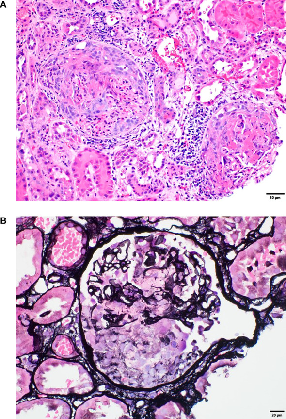 Case Report: Immune checkpoint inhibitor-induced multiorgan vasculitis successfully treated with rituximab.