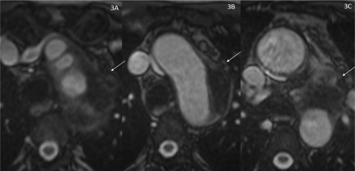 Pictorial review of computed tomography and magnetic resonance imaging findings of cardiovascular manifestations of IgG4-related disease.