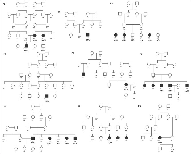 Limb-Girdle Muscular Dystrophy Type 2B (LGMD2B) caused by Pathogenic Splice and Missense Variants of <i>DYSF</i> Gene among Iranians with Muscular Dystrophy.