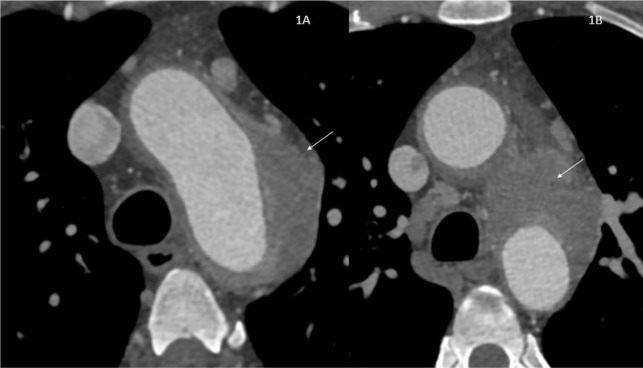 Pictorial review of computed tomography and magnetic resonance imaging findings of cardiovascular manifestations of IgG4-related disease.