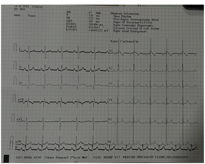 Progressive Memory Decline in a Patient With Atrial Septal Defect: Case Report and Literature Review.