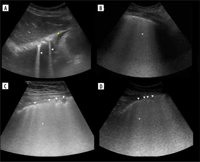 Lung ultrasound in a nutshell. Lines, signs, some applications, and misconceptions from a radiologist's point of view.