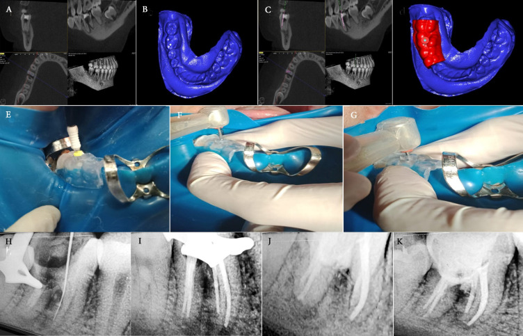 Multiple Endodontic Guides for Root Canal Localization and Preparation in Furcation Perforations: A Report of Two Cases.