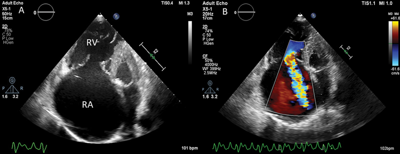 Idiopathic Isolated Right Ventricular Cardiomyopathy: A Rare Case Report.