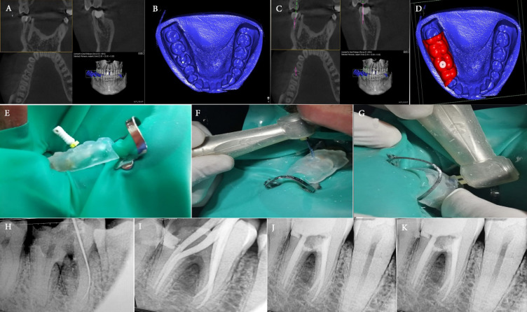 Multiple Endodontic Guides for Root Canal Localization and Preparation in Furcation Perforations: A Report of Two Cases.