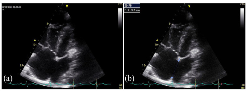 Progressive Memory Decline in a Patient With Atrial Septal Defect: Case Report and Literature Review.