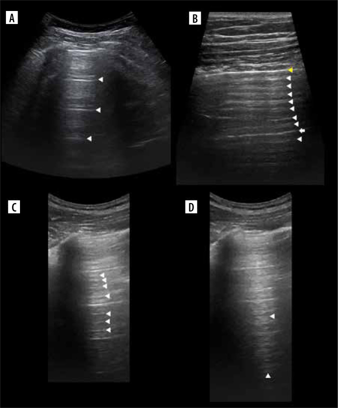 Lung ultrasound in a nutshell. Lines, signs, some applications, and misconceptions from a radiologist's point of view.