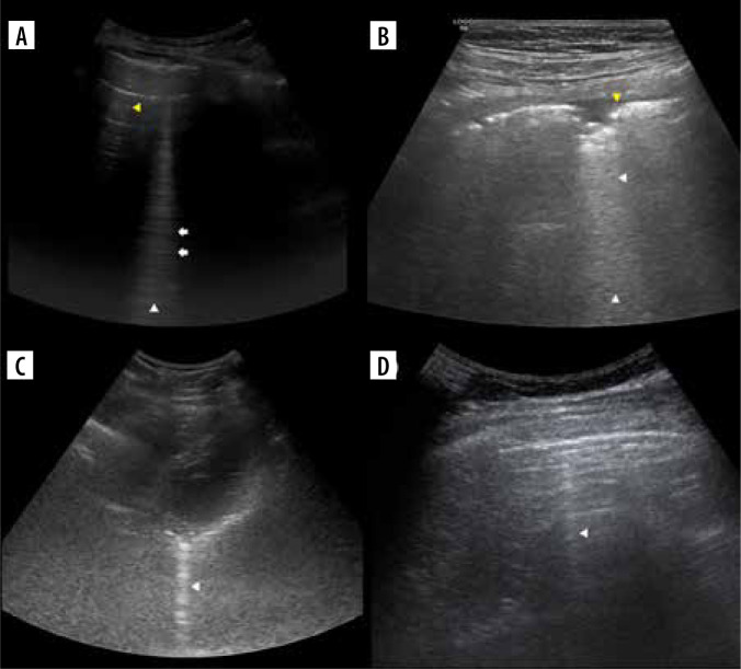 Lung ultrasound in a nutshell. Lines, signs, some applications, and misconceptions from a radiologist's point of view.