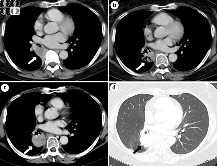 Sarcoid-Like Granulomatosis of the Lung Related to Durvalumab After Chemoradiation for Pulmonary Squamous Cell Carcinoma.