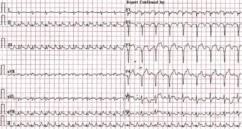 Idiopathic Isolated Right Ventricular Cardiomyopathy: A Rare Case Report.