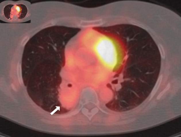 Sarcoid-Like Granulomatosis of the Lung Related to Durvalumab After Chemoradiation for Pulmonary Squamous Cell Carcinoma.