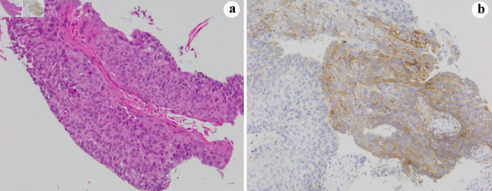 Sarcoid-Like Granulomatosis of the Lung Related to Durvalumab After Chemoradiation for Pulmonary Squamous Cell Carcinoma.