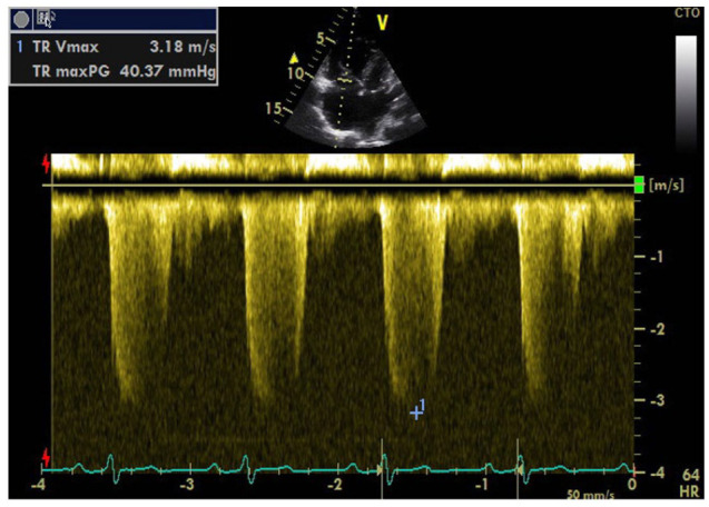 Progressive Memory Decline in a Patient With Atrial Septal Defect: Case Report and Literature Review.