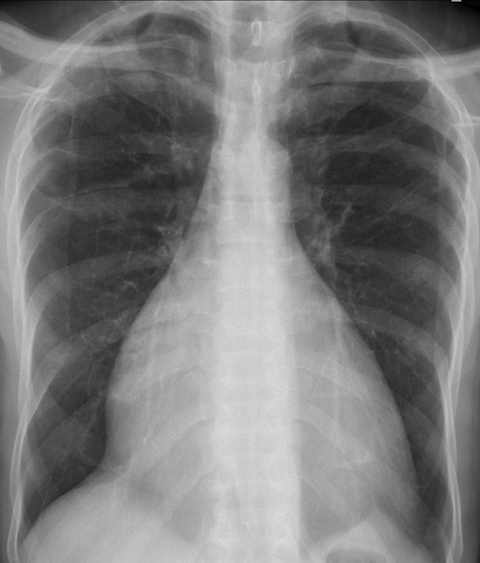 Idiopathic Isolated Right Ventricular Cardiomyopathy: A Rare Case Report.