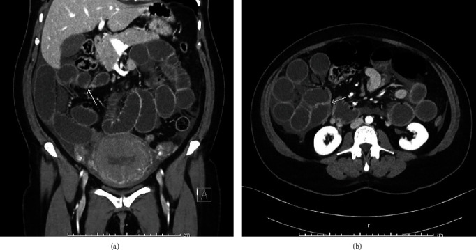 Small Bowel Obstruction in Postpartum Vaginal Delivery due to Prior Abdominal Adhesions Case Report.