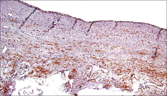 Myofibroblasts in Odontogenic Cysts and Tumors: An Immunohistochemical Study.