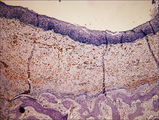 Myofibroblasts in Odontogenic Cysts and Tumors: An Immunohistochemical Study.