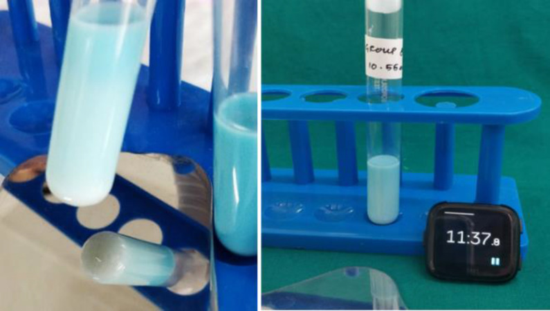 Correlation of Ora Test and Caries Assessment Spectrum and Treatment Index (CAST) to Evaluate Caries Activity in 5-to-8-Year-Old Children.