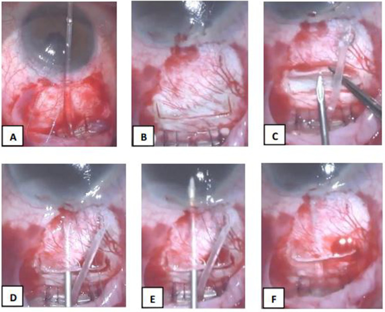 Comparison of Short and Long-Tunnel Needle Track for Ahmed Glaucoma Valve Implantation in a Private Eye Center in the Philippines: A Retrospective Study.