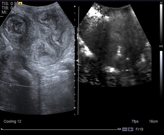 Characterization of uterine involution using B-mode ultrasonography, color Doppler and elastography (acoustic radiation force impulse) for assessing postpartum in Santa Inês ewes.