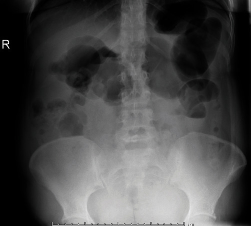 Small Bowel Obstruction in Postpartum Vaginal Delivery due to Prior Abdominal Adhesions Case Report.