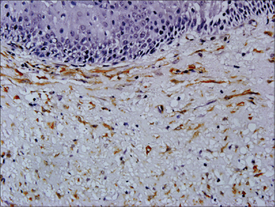 Myofibroblasts in Odontogenic Cysts and Tumors: An Immunohistochemical Study.