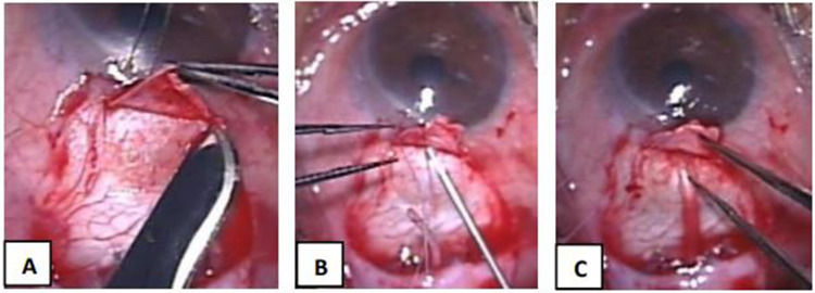 Comparison of Short and Long-Tunnel Needle Track for Ahmed Glaucoma Valve Implantation in a Private Eye Center in the Philippines: A Retrospective Study.