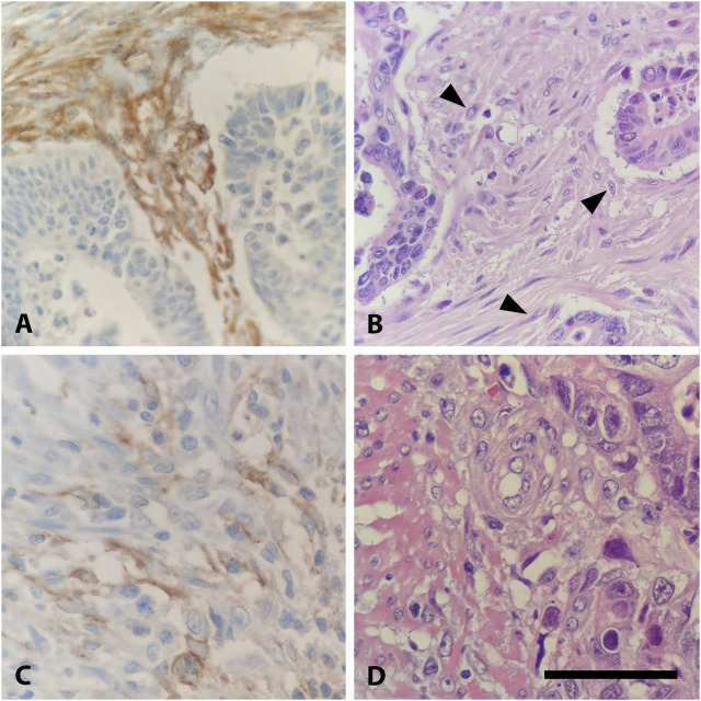 Fibroblast activation protein-α expression in fibroblasts is common in the tumor microenvironment of colorectal cancer and may serve as a therapeutic target.