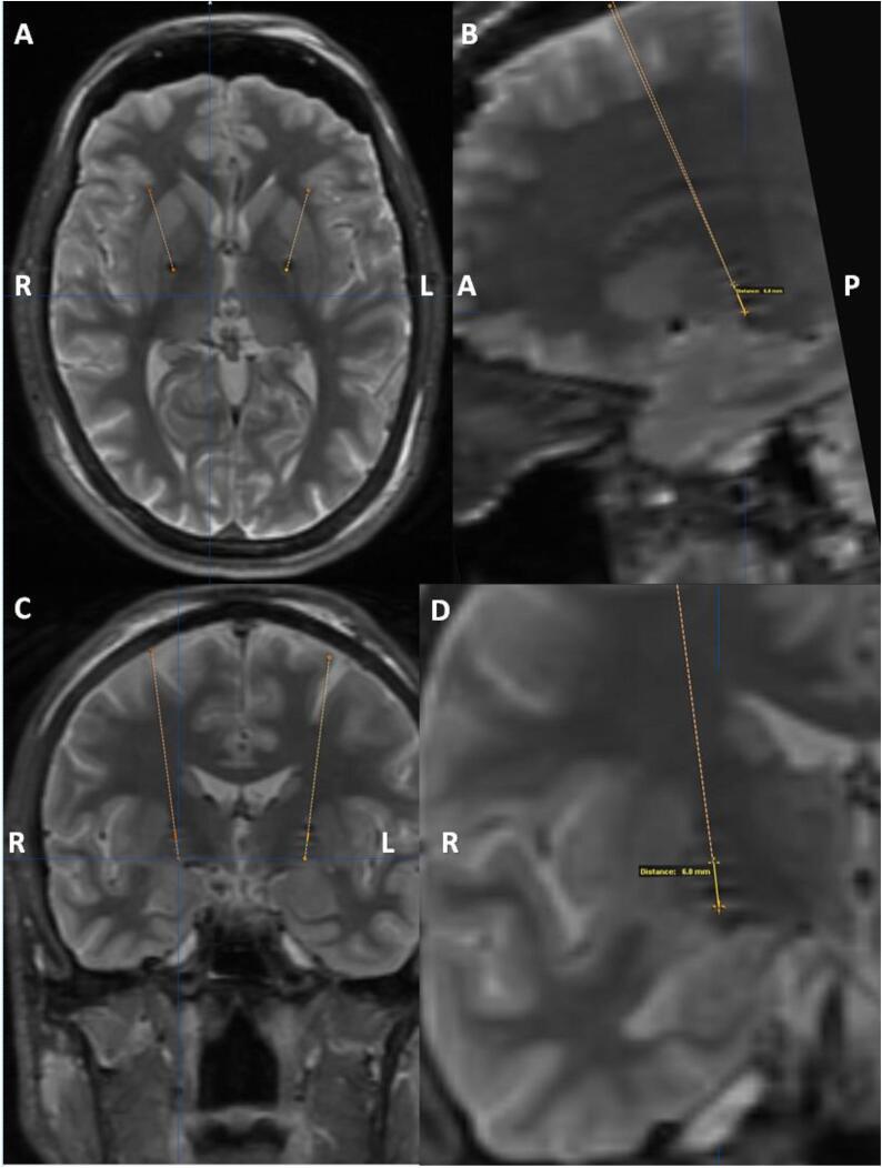 Pallidal stimulation-induced psychosis and suicidality in Parkinson’s disease