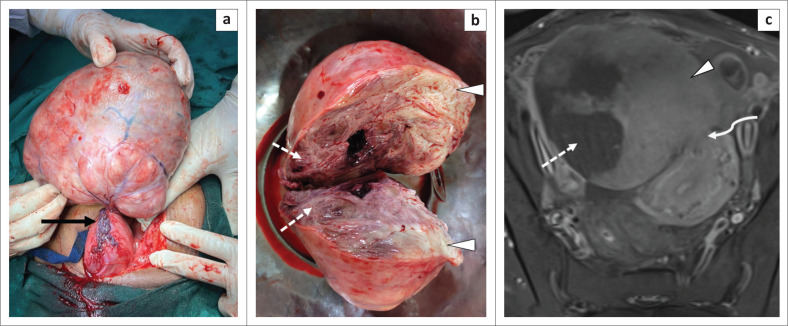 Torsion of a huge subserosal uterine leiomyoma: A challenging case of acute abdomen.