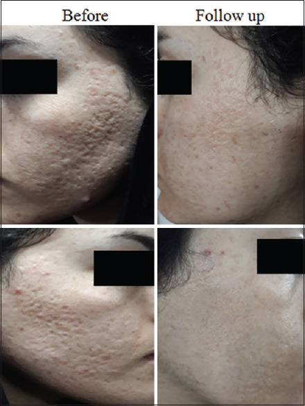 A Comparative Study on the Usefulness of Fractional CO<sub>2</sub> and Fractional Er:YAG in Acne Scars: A Split-Face Trial.