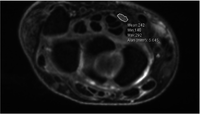 Carpal Tunnel Syndrome in Patients with Psoriatic Arthritis: Ultrasonography and Magnetic Resonance Imaging Findings.