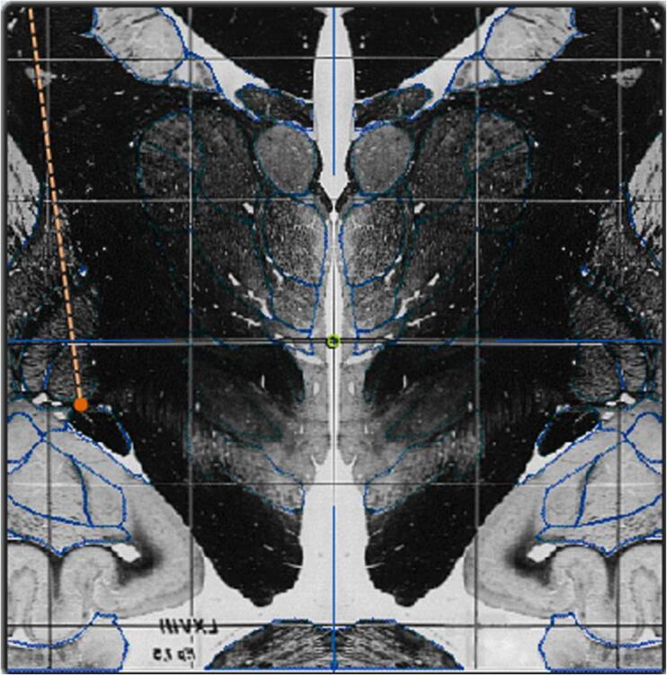 Pallidal stimulation-induced psychosis and suicidality in Parkinson’s disease